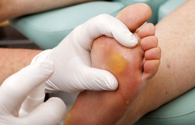 Callus and Corn Treatment