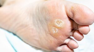 At-Home Foot Care Edmonton 3 At-Home Foot Care Edmonton